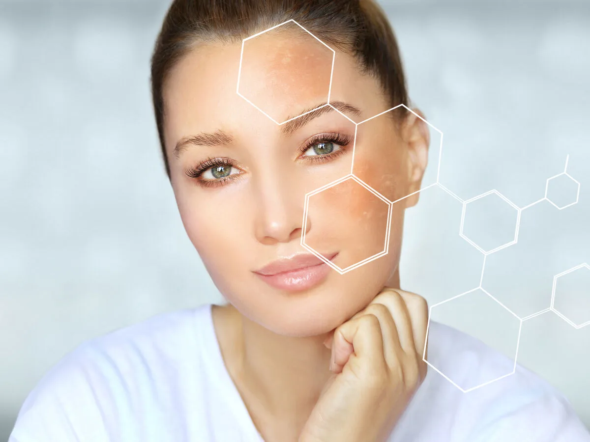 Pigmentation & Melasma