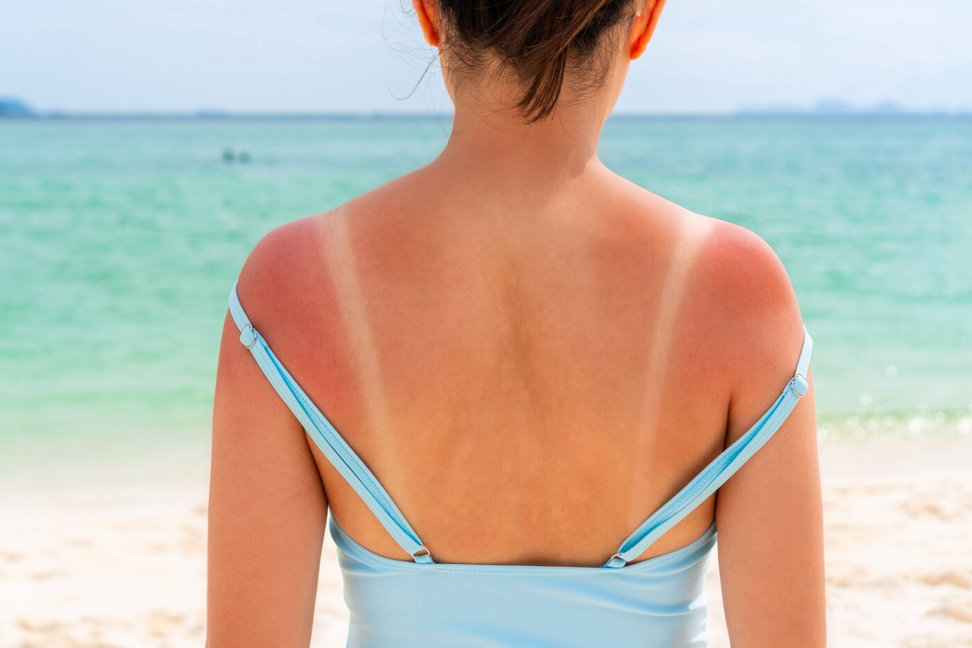 Woman with sunburned shoulders on the beach — visible sun damage on skin